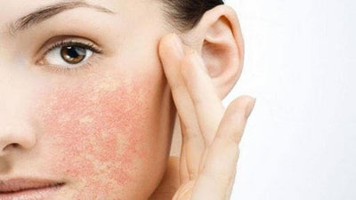 Tác Dụng Phụ Của Tretinoin Cần Phải Thận Trọng