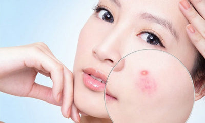 Bách khoa toàn thư về mụn (Phần 1)