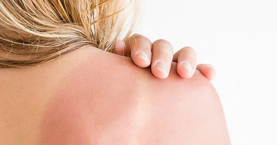 Cách phục hồi da bị cháy nắng tại nhà an toàn và hiệu quả