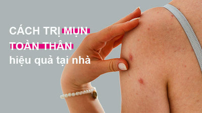Cách trị mụn toàn thân hiệu quả tại nhà ngăn ngừa tái phát