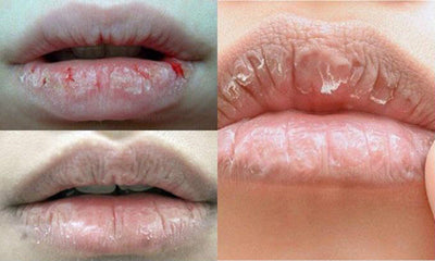 Chuyên gia hướng dẫn giải pháp trị môi khô nứt nẻ hiệu quả