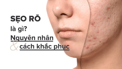 Nguyên nhân bị sẹo rỗ và cách khắc phục sẹo rỗ hiệu quả từ chuyên gia