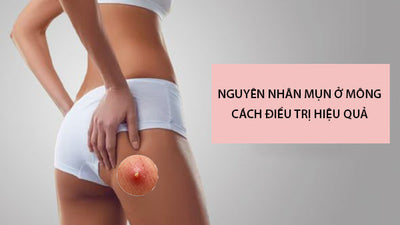 Nguyên nhân gây ra mụn ở mông và cách điều trị hiệu quả
