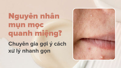 Nguyên nhân, cách khắc phục mụn mọc quanh miệng và cằm