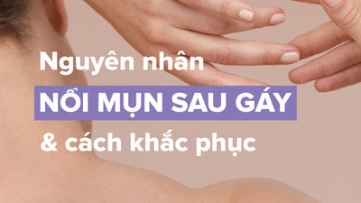 Nguyên nhân nổi mụn sau gáy và cách khắc phục chuẩn chuyên gia