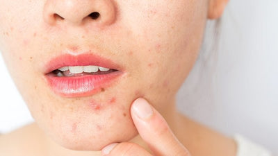 Trị liệu các vấn đề về da bằng sản phẩm kê theo đơn như thế nào?