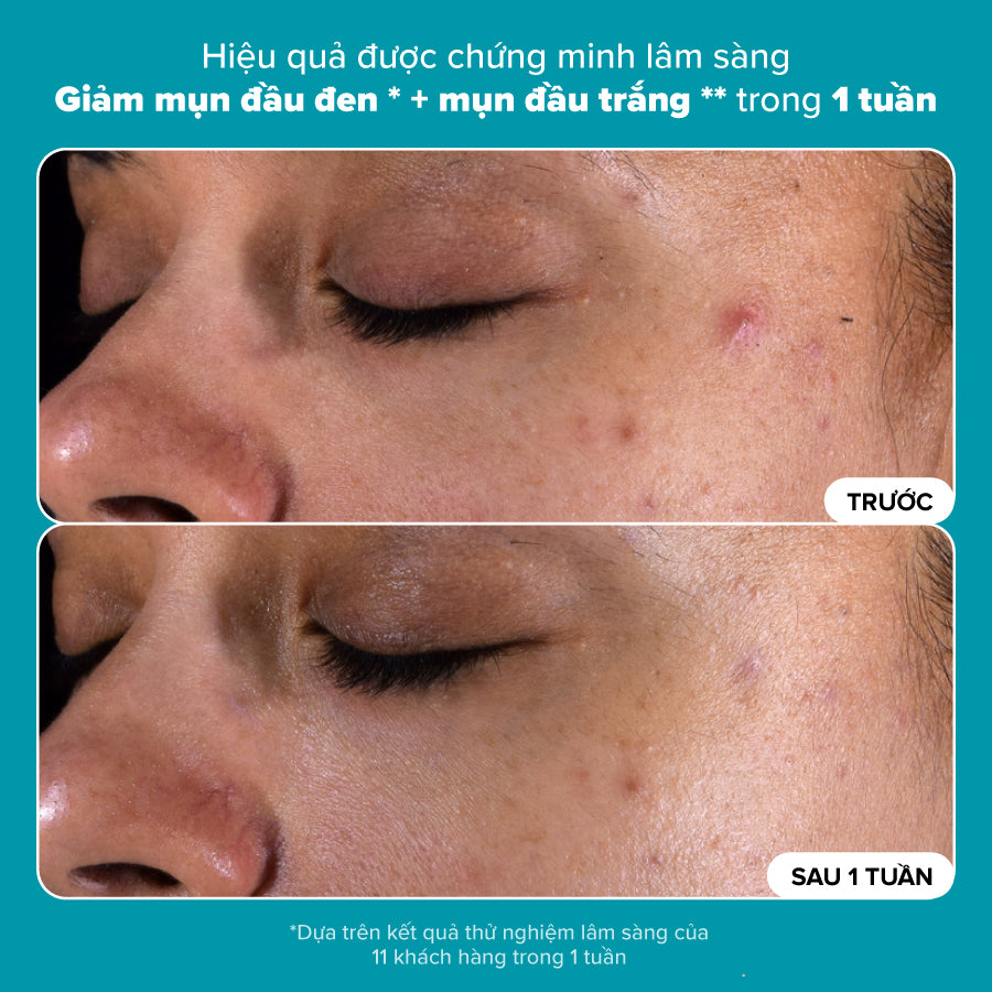 Dung dịch loại bỏ tế bào chết Skin Perfecting 2% BHA Liquid Exfoliant