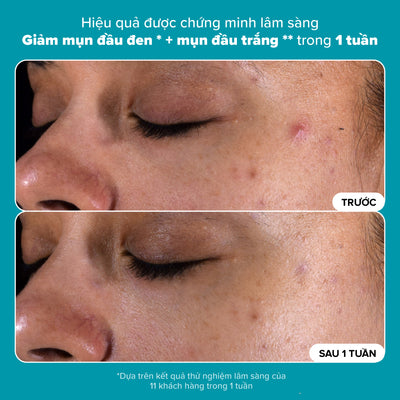 Dung dịch loại bỏ tế bào chết Skin Perfecting 2% BHA Liquid Exfoliant