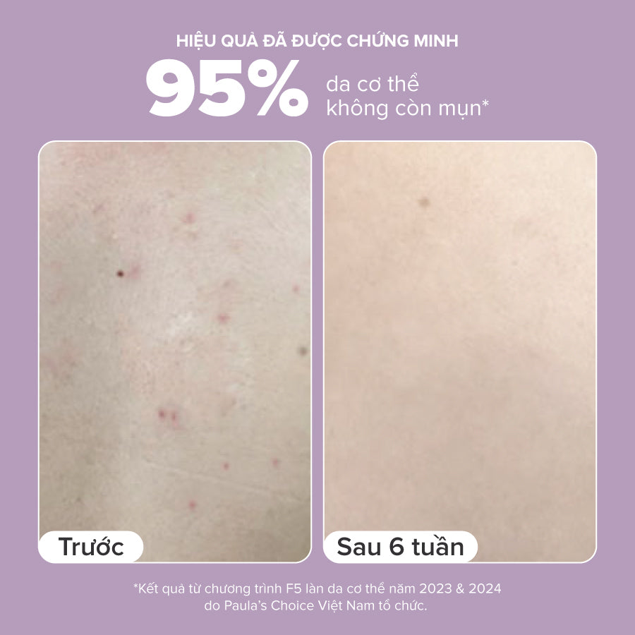 Kem dưỡng thể hỗ trợ giảm mụn và làm mịn da 2% BHA Body Smoothing Spot Exfoliant