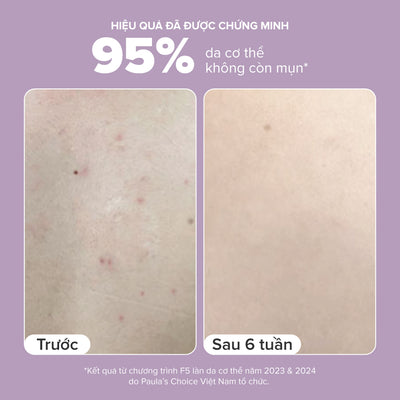Kem dưỡng thể hỗ trợ giảm mụn và làm mịn da 2% BHA Body Smoothing Spot Exfoliant