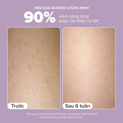 Kem dưỡng thể hỗ trợ giảm mụn và làm mịn da 2% BHA Body Smoothing Spot Exfoliant