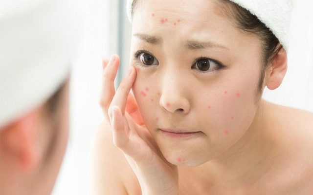 Nắm được quy tắc trong loại bỏ mụn sẽ giúp bạn sớm cải thiện được những nốt mụn xấu xí trên mặt.