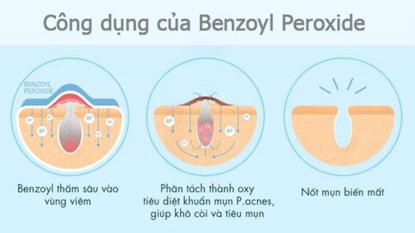 công dụng của Benzoyl Peroxide là gì, Benzoyl Peroxide có tác dụng gì
