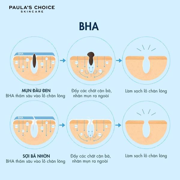 Hướng dẫn điều trị mụn ẩn bằng BHA