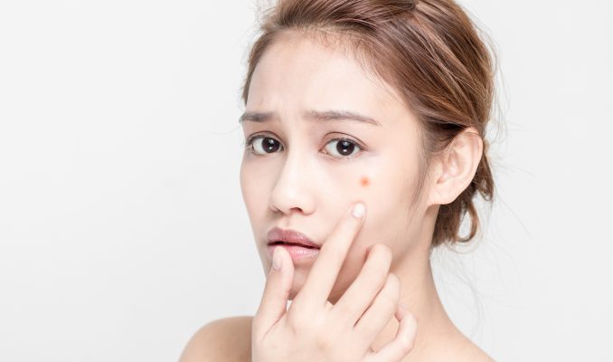 Mụn mủ, mụn viêm có thể để lại sẹo thâm xấu xí trên gương mặt.
