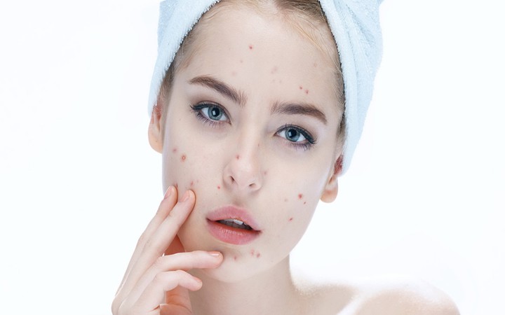 cách chăm sóc da mặt bị mụn ẩn