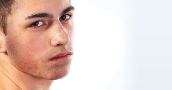 Bệnh nám da mặt ở nam giới: nguyên nhân và cách khắc phục