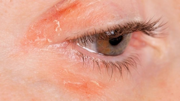 nguyên nhân da vùng mắt bị khô, tại sao da mắt bị khô