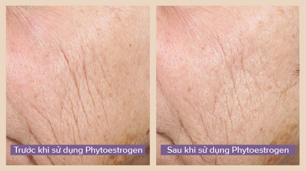 trước và sau khi sử dụng Phytoestrogen