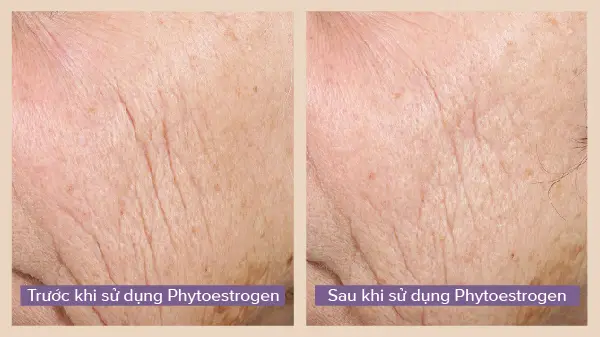 trước và sau khi sử dụng Phytoestrogen
